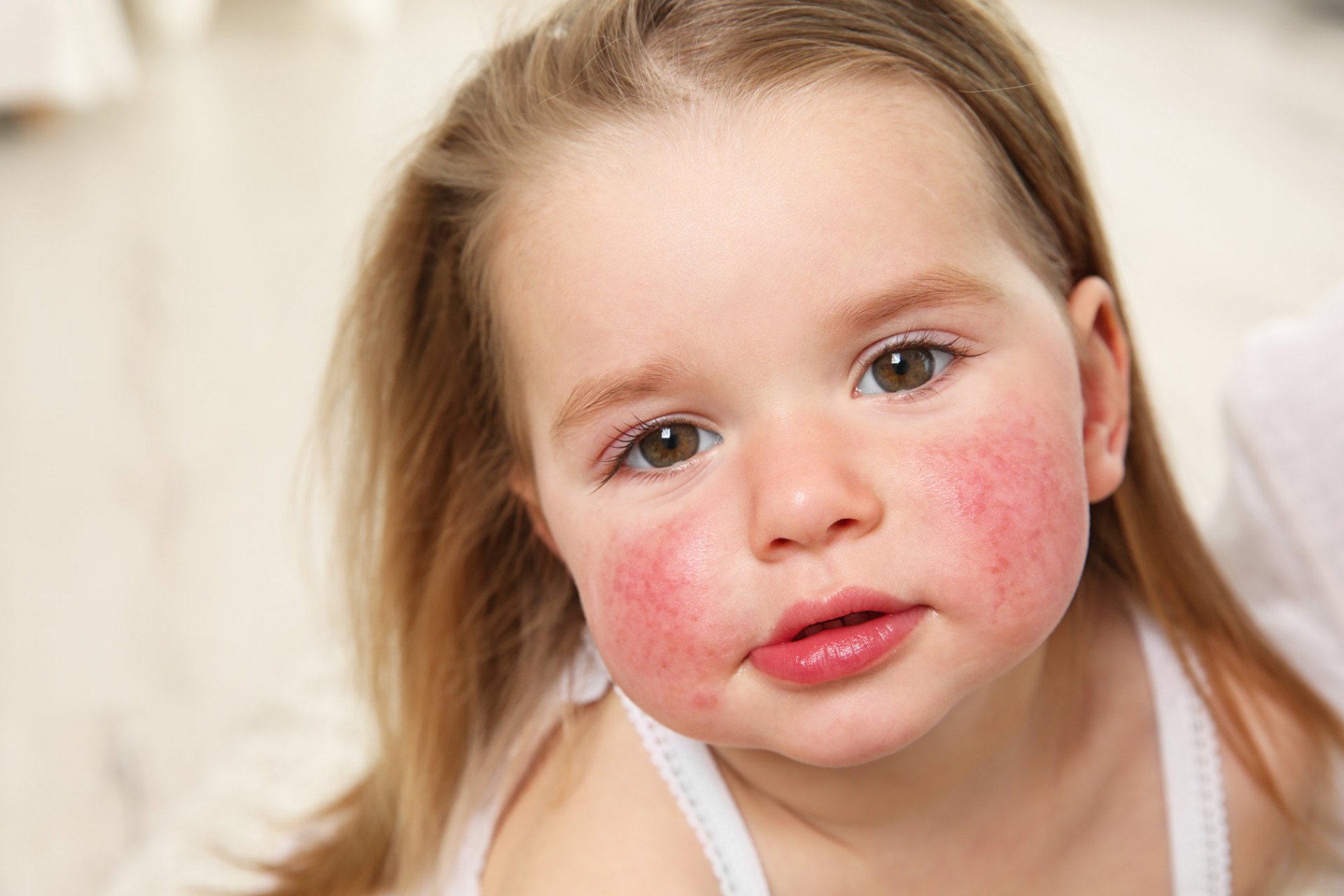 Психосоматика аллергии у ребенка: связь между умом и телом